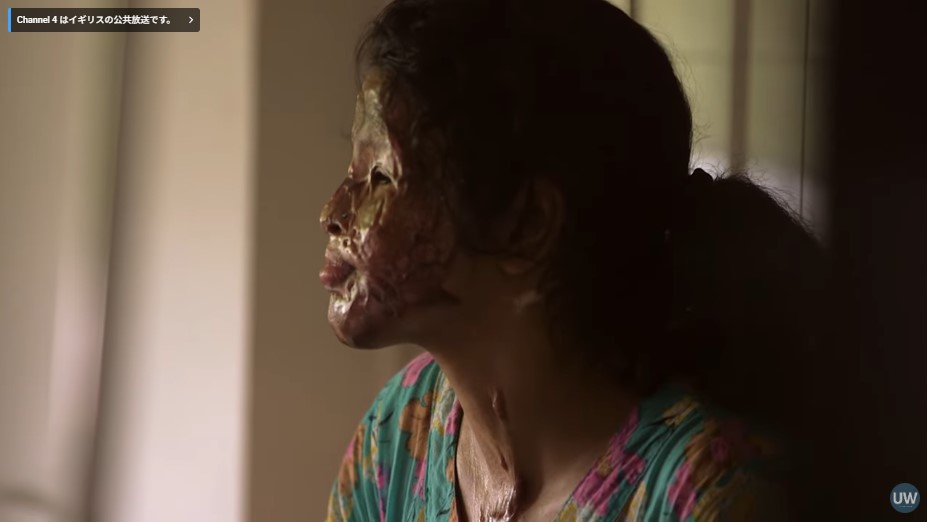 元交際者による酸暴力被害者のシュミさん